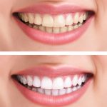 Sbiancamento dentale: un servizio estetico sempre più richiesto