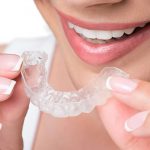 Trattamento Invisalign: tutto quello che devi sapere sugli aligner trasparenti